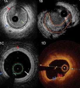 ivus octus